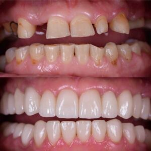 Cosmetic restorations with crowns and veneers