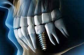 single implant and crown 