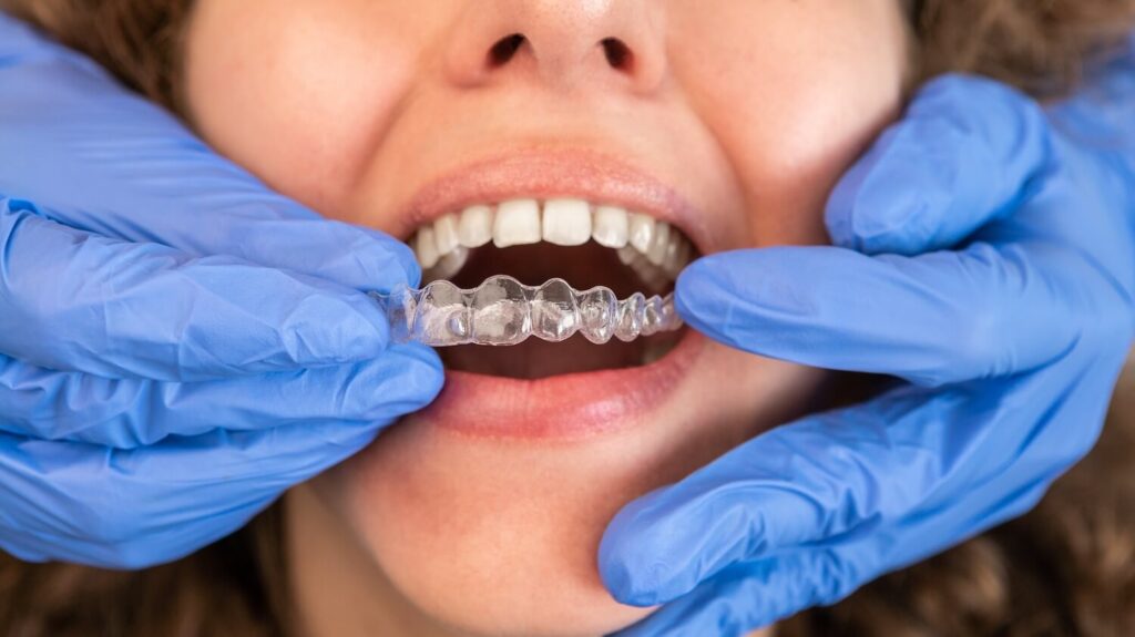 What is The Process of Getting Invisalign expect happens