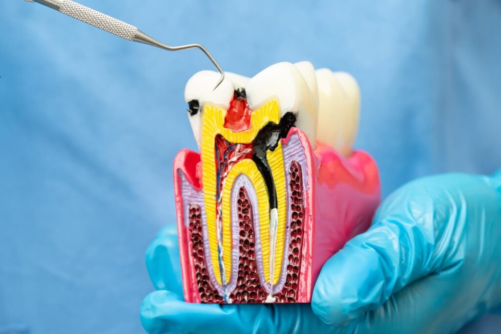 Why You No Longer Have To Be Afraid of Getting a Root Canal