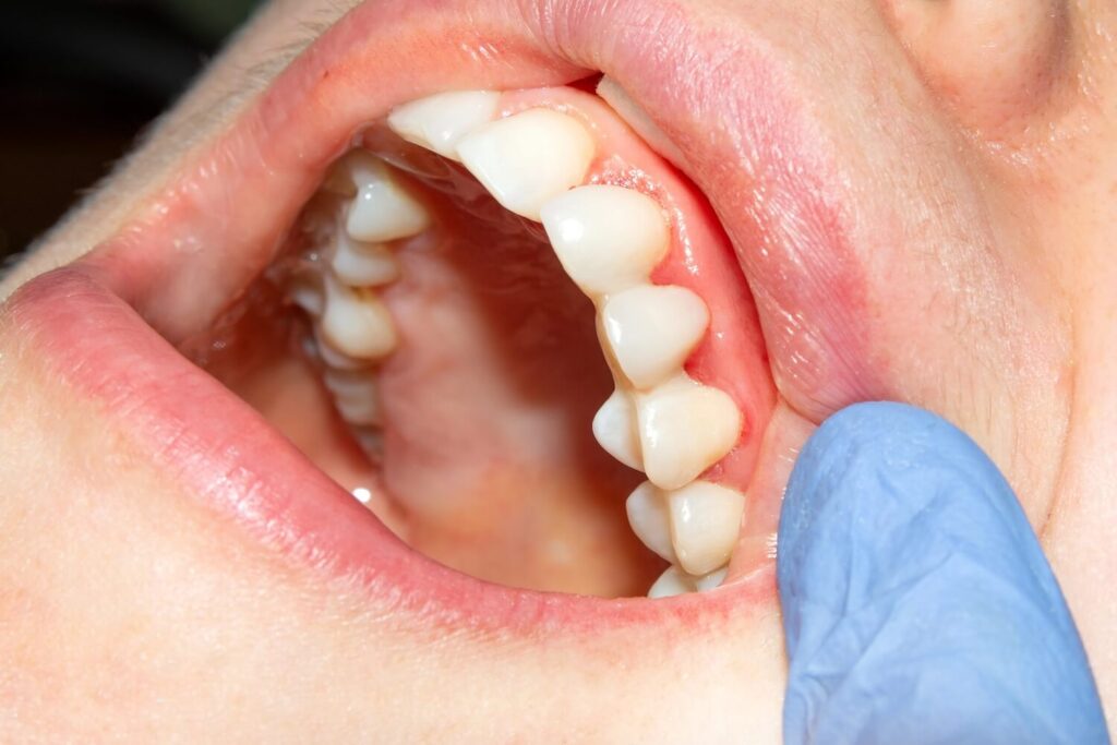 What Is The Best Type Of Dental Filling? composite fillings